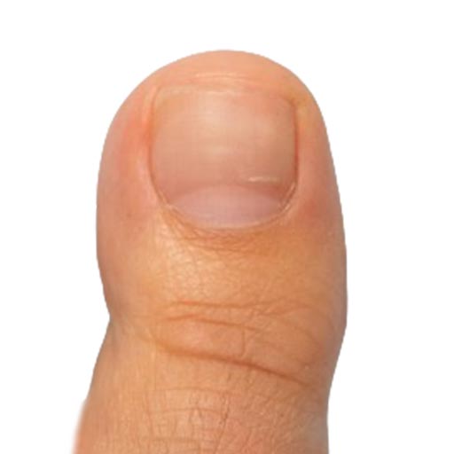 אחרי טיפול בפטרת ציפורניים